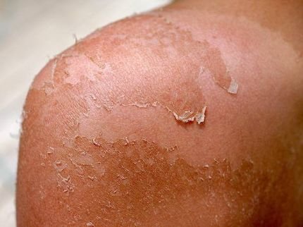 Sunburn Skin Peeling