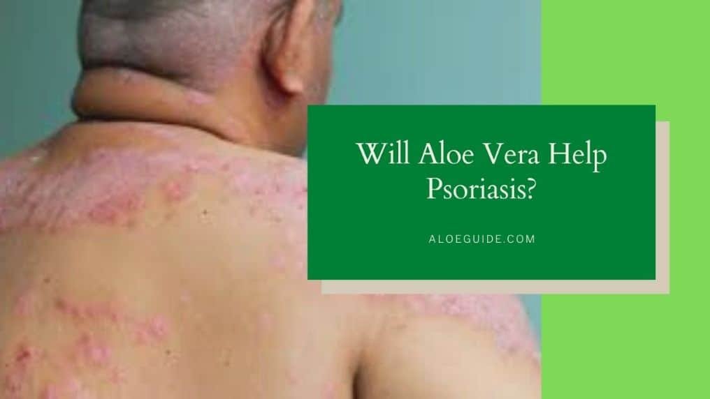 Aloe Vera For Psoriasis