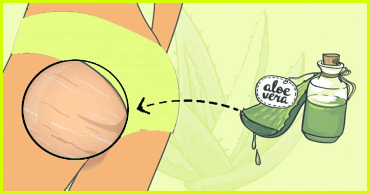 How To Use Aloe Vera To Treat Stretch Marks 2